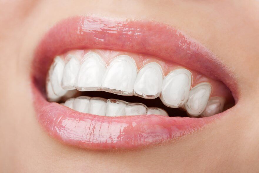 Unveiling the Transformation: The Benefits of Invisalign