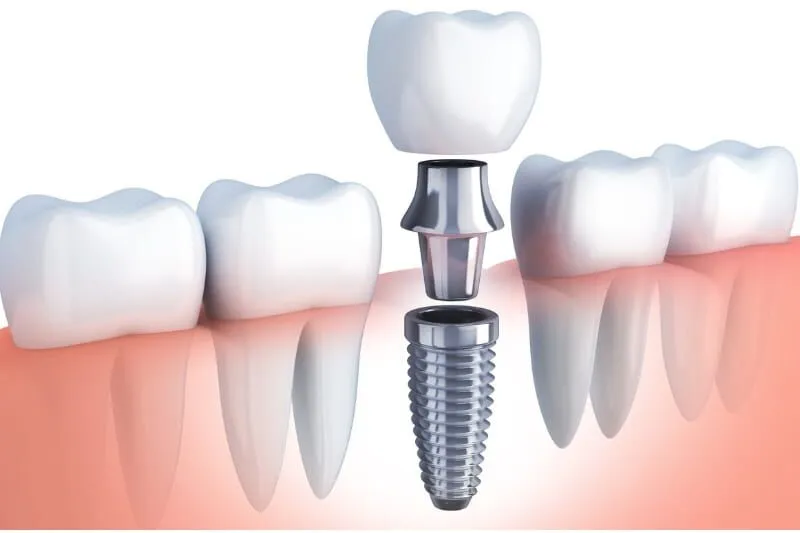 Transform Your Smile: Three Compelling Reasons to Consider Dental Implants