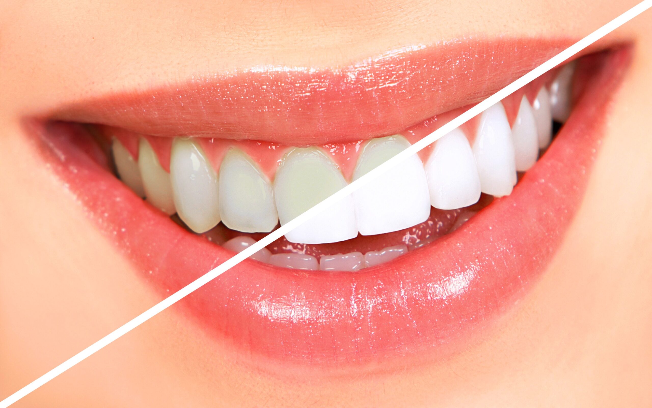 5 Facts About Teeth Whitening You Should Know