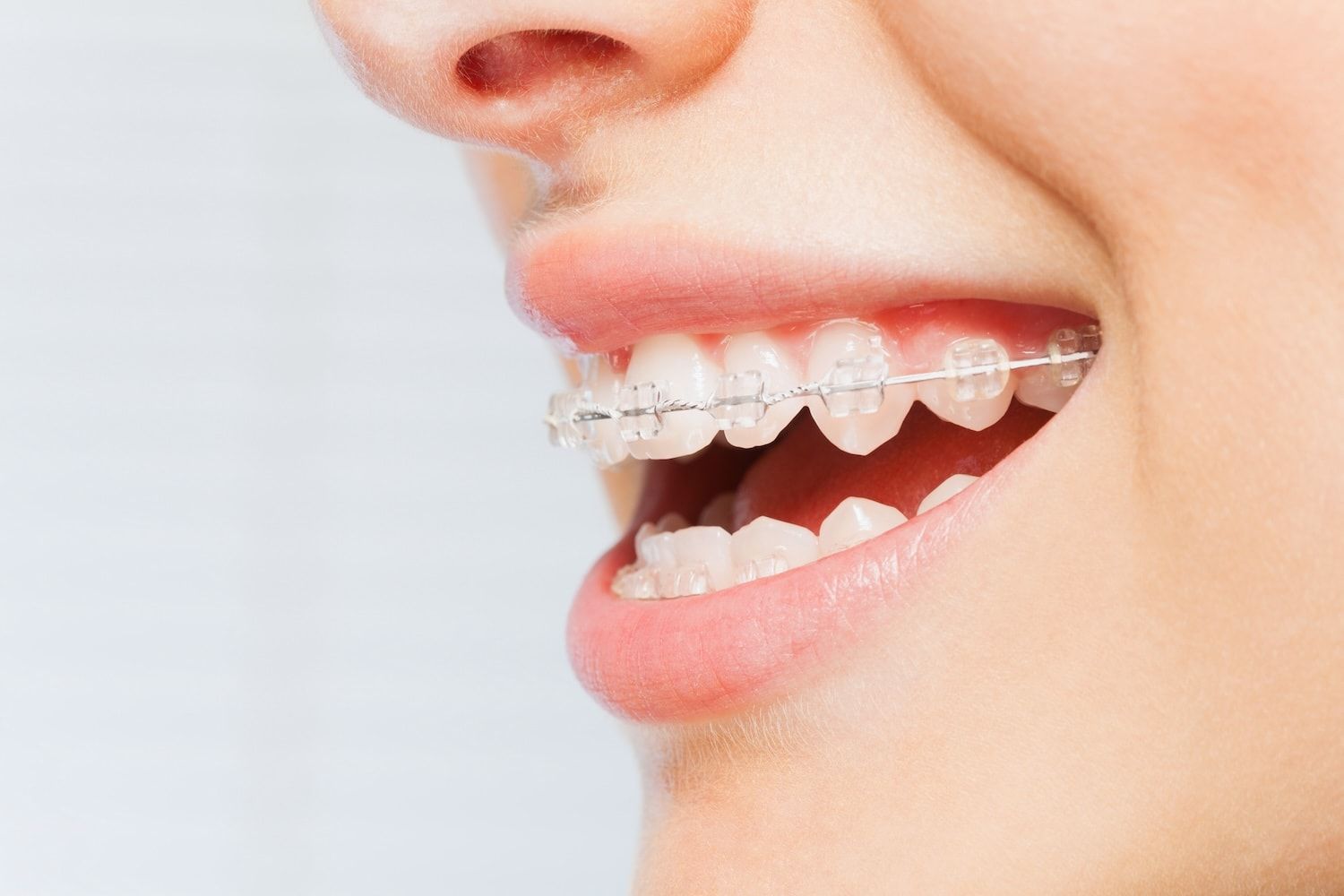 Innovations in Orthodontics: Beyond Traditional Braces